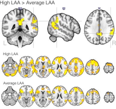 Figure  5.  Brain  activation  in  response  to  ungrammatical  as  compared to grammatical items  significantly  greater  for  the  High than for the Average LAA  participants  (top  panel)  and  group mean activation maps for  High  and  Average  LAA  pa