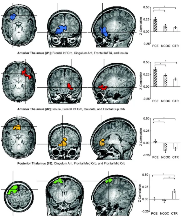Figure 2. Localization of group-wise (PCE, NCOC, CTR) functional connectivity differences at  the cluster-level and post-hoc comparisons by group