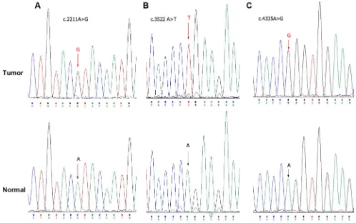 Figure 4: Exome sequencing of PBRM1 by Sanger sequence in bladder cancer tissues. Sanger sequence analysis showed genetic alterations A