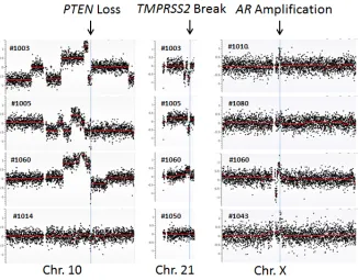Figure 1: cfDNA genomic abnormalities detected at specific chromosomal loci. PTEN loss at chromosome 10, TMPRSS2 at chromosome 21, and AR amplification at chromosome X are shown