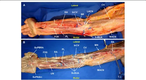 Figure 2 Right upper limb showing the anomalous course of the superficial brachioulnar artery in an above fascia (A) and a deeper tofascia (B) dissection