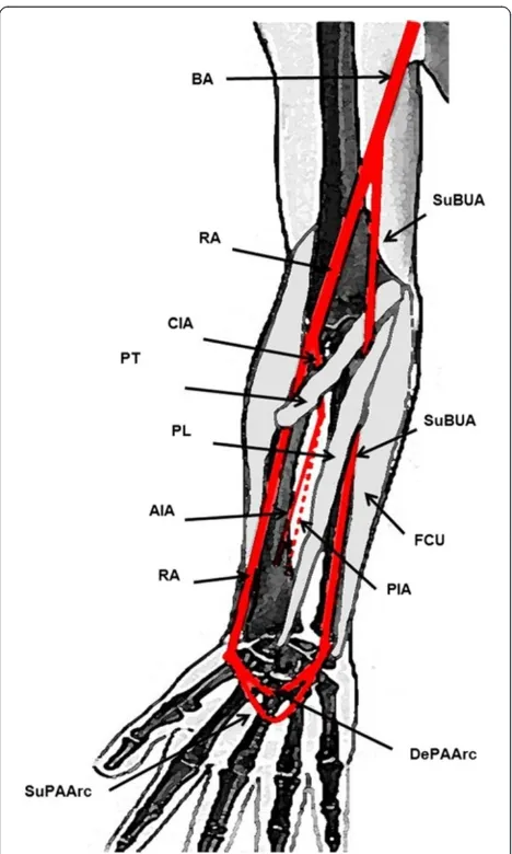 Figure 3 Schematic drawing of the origin and distribution ofthe superficial brachioulnar artery and its relation with themedial epicondyle muscles