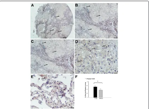 Figure 2 HIF-1a immunohistochemical staining in sarcoidosis lung samples. Representative tissue microarray section immunostained withmonoclonal antibody HIF-1a demonstrating diffuse cytoplasmic reaction of weak intensity in epithelioid cells within granulo