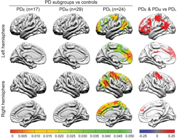 Figure 1 Comparison of local gyrification index between Parkinson disease (PD) subgroups and controls (left) and among PD subgroups (right) at baseline