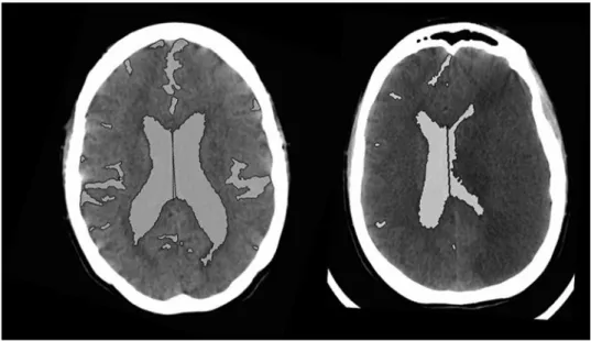 Fig. 1. CSF spaces outlined on CT scan slice at baseline and peak edema in sample patient