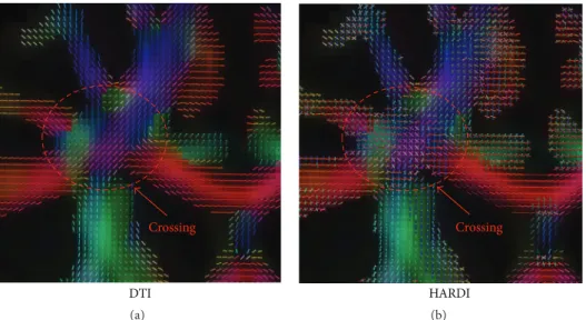 Figure 1: Directional glyphs at the intersection of the left corticospinal tract and the corpus callosum given by (a) the DTI method and (b) the HARDI method.