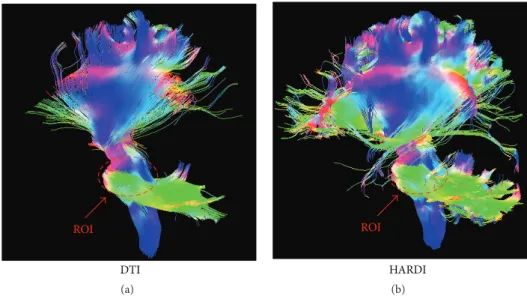 Figure 2: Tractography results based on a seed ROI at the brain stem with (a) the DTI method and (b) the HARDI method.