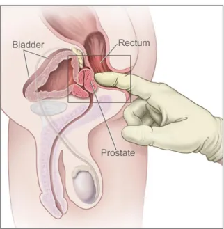 Figure 1.1: Digital rectal exam (DRE); the doctor inserts a gloved, lubricated finger into the rectum to feel and check the prostate