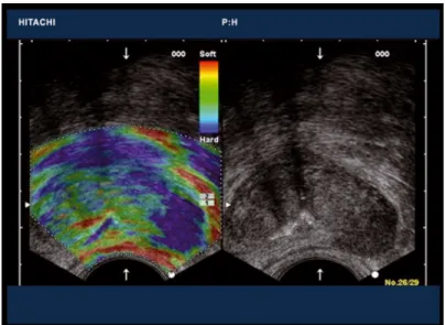 Figure 1.2: An example elastography result for the prostate using a rectal probe. Left:
