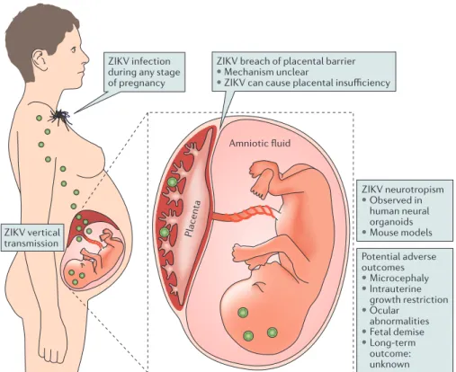 Figure 2 | Vertical transmission and congenital disease induced by ZIKV. After crossing the  placental barrier, Zika virus (ZIKV) infection can have devastating consequences for the developing  fetus