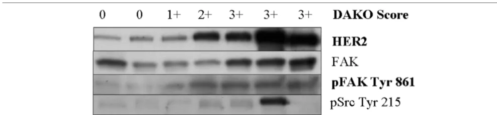 Figure 4Upregulation of tyrosine phosphorylation of focal adhesion kinase (FAK) at tyrosine 861 in HER2-overexpressing breast tumorsUpregulation of tyrosine phosphorylation of focal adhesion kinase (FAK) at tyrosine 861 in HER2-overexpressing breast tumors