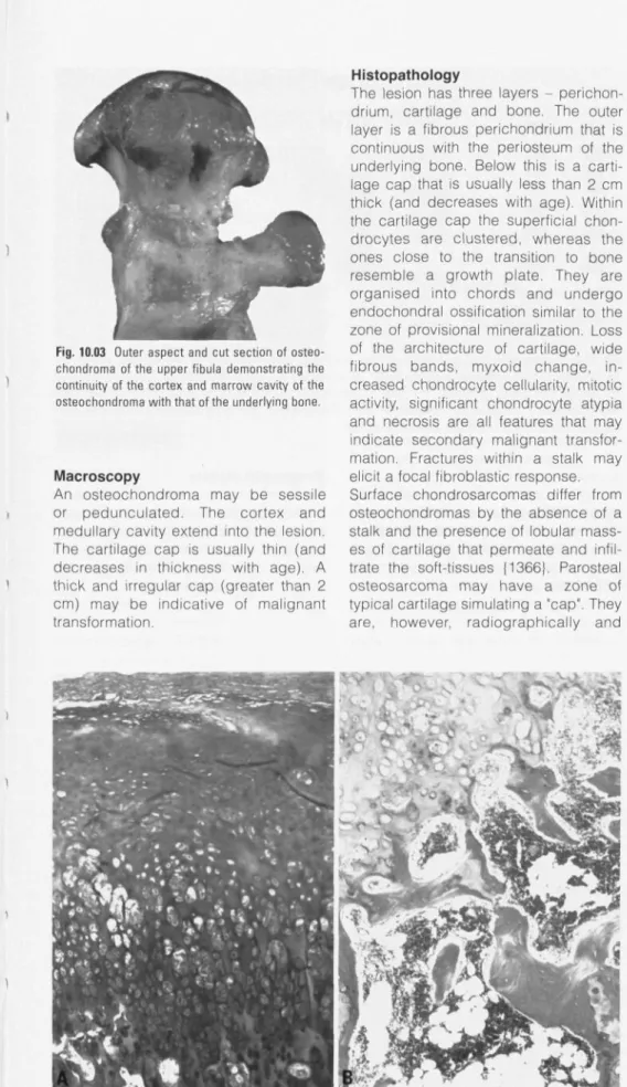 Fig. 10.03 Outer aspect and cut section of osteo- osteo-chondroma of the upper fibula demonstrating the continuity of the cortex and marrow cavity of the osteochondroma with that of the underlying bone.