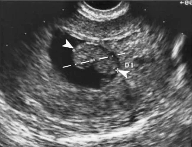 Figure 2: Early fetal pole visualization by ultrasound. The pole is indicated by the two arrowheads.