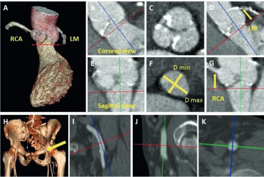 Figure 1. Multi-detector row computed tomography may give critical information in patients undergo- undergo-ing transcatheter aortic valve implantation