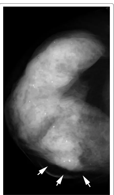 Figure 9 Invasive lobular carcinoma in a 67-year-old woman with left nipple stiffness and retraction