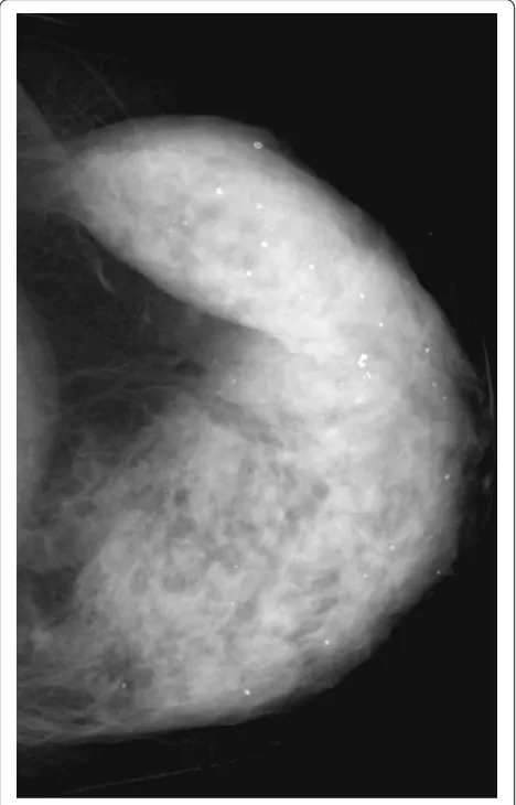 Figure 12 Multifocal invasive ductal carcinoma in a 53-year-oldwoman with dense breasts