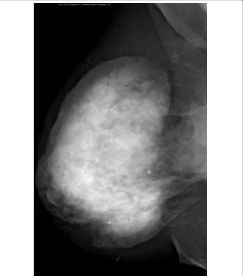 Figure 13 Multifocal invasive ductal carcinoma in a 53-year-old woman with dense breasts
