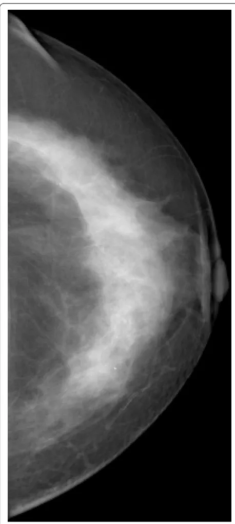 Figure 4 Invasive lobular carcinoma in a 67-year-old womanwith left nipple stiffness and retraction