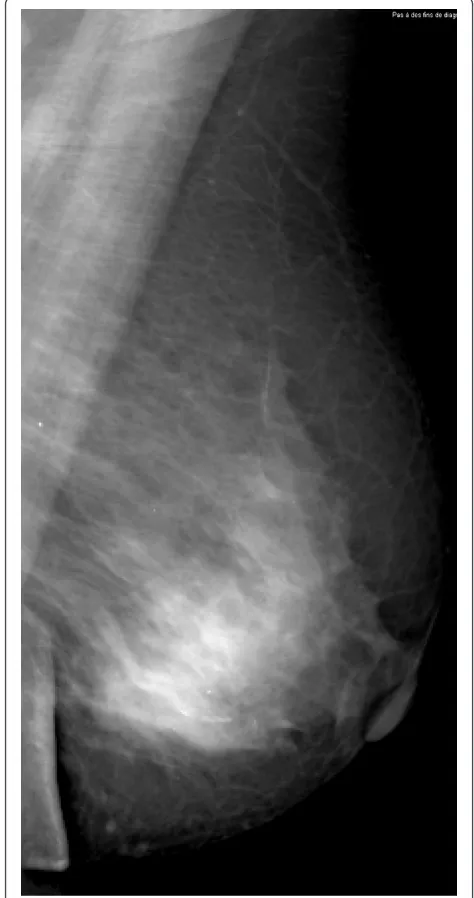 Figure 6 Invasive lobular carcinoma in a 67-year-old womanwith left nipple stiffness and retraction