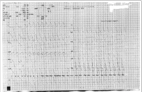 Fig. 1 Ventricular tachycardia following intentional ingestion of 2500 mg amitriptyline in a female patient on admission