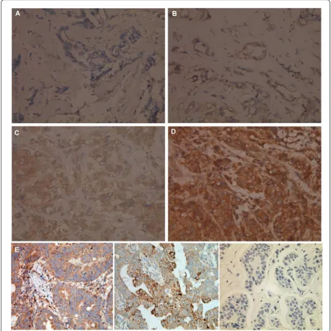 Figure 6 Variable CIP2A expression in breast tumor tissue from patients with triple negative breast cancers