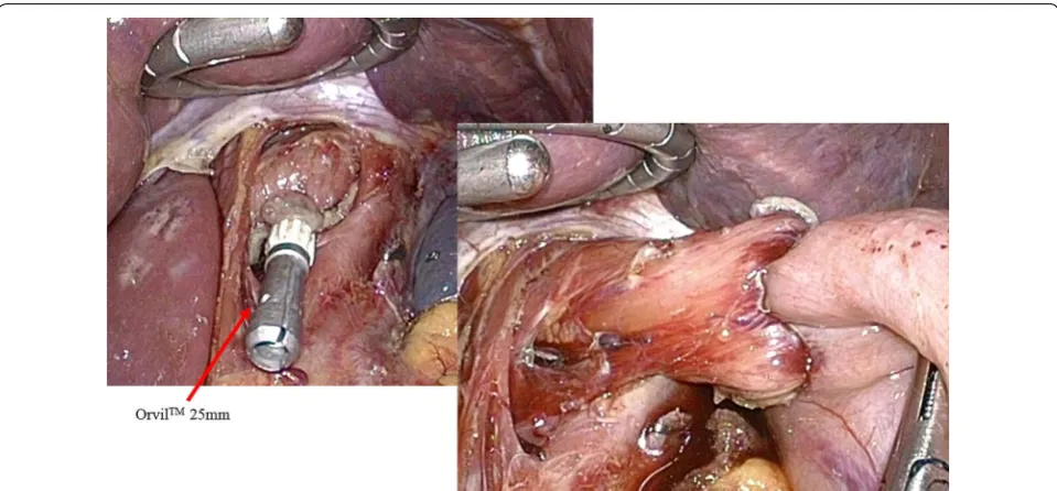 Fig. 2 Esophagojejunostomy using a transoral anvil. A transoral anvil (OrVil™ 25 mm) was used for esophagojejunostomy