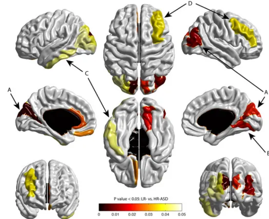 Figure 2. Cortical regions showing significant expansion in surface area from 6-12 months in  HR-ASD