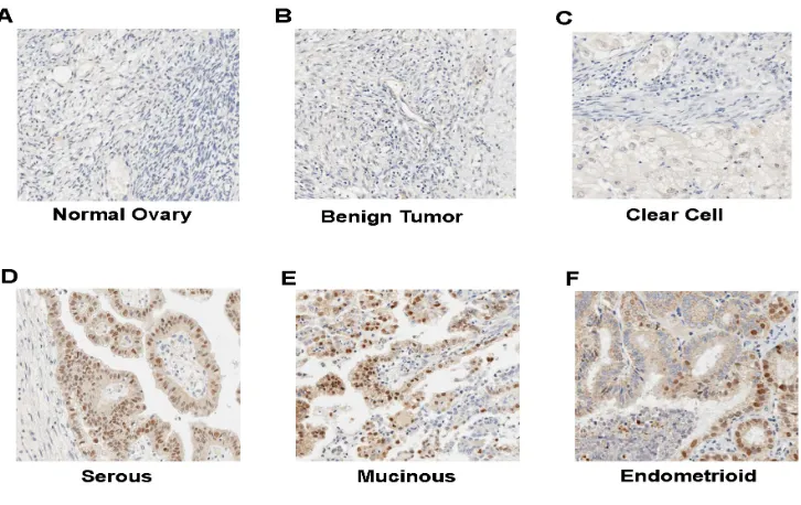 Figure 2: Immunohistochemistry of CCNE1 on ovary tumor specimens. A. Normal ovary tissue