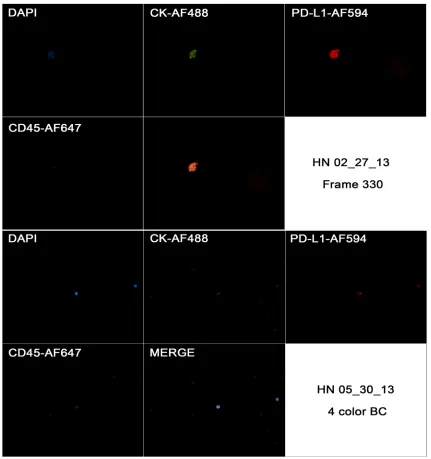 Figure 9: Captured images from a CTC in a HNSCC case (HN 02/27/13) showing positivity to CK, negativity for CD45 and strong and focal positivity to CD274 in first image (frame 330), and the same markers in a blood cell from a different case (HN 05/30/13)