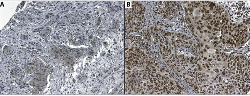 Figure 6: Microphotography of A. Cytoplasmic expression of CD274 in a positive case, and B