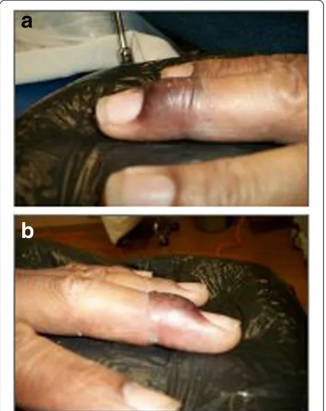Figure 1 Pre-treatment appearance of the lesion front and sideviews. The Patient presented with a pigmented scaly plaque on thedorsum of the finger and nail bed.