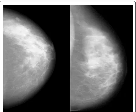 Figure 7 Examples of images with low score values calculatedwith the final prediction model and a low risk of breast cancer(left), and images with high score values and a high risk ofbreast cancer (right)