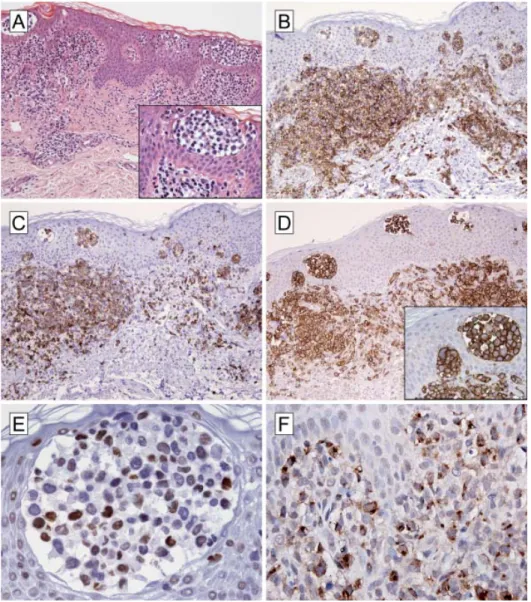 Figure 1. Histopathologic features of a representative patient with Sézary syndrome. (A) The  hematoxylin-eosin staining of the lesion showed a superfi cial band-like dermal infi ltrate and epidermal  Pautrier microabscesses with CD4+ (B) CD3+ (C) neoplast