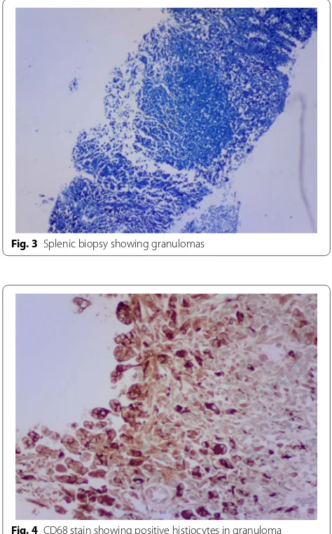 Fig. 4 CD68 stain showing positive histiocytes in granuloma