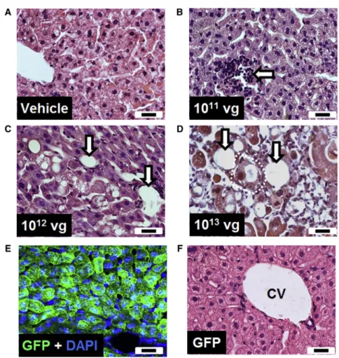 Figure 2. Intravenous Injection of the First- First-Generation Vector Resulted in Pathological Changes in the Liver