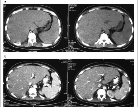 Fig. 2 a, b Computed tomographic (CT) scan of abdomen showing hepatosplenomegaly with multiple isodense lesions in liver and spleen