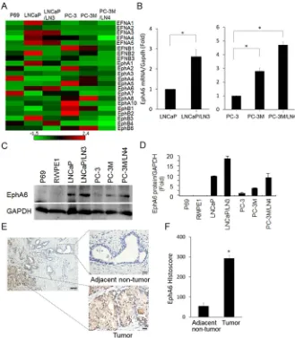 Figure 1: EphA6 mRNA and protein expression is up-regulated in CaP lymph node metastatic cell lines and CaP tumor tissues