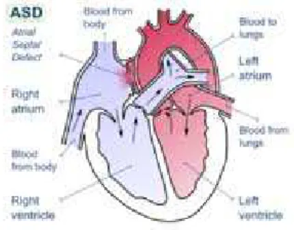 Figure 2.3:  Atrial Septal Defects   http://www.merckmanuals.com/home/s ec23/ch265/ch265b.html#v815583