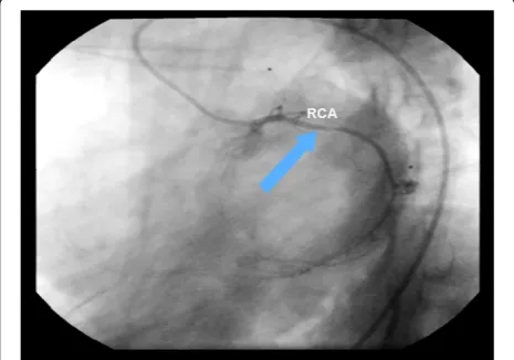 Figure 7 The cineangiocornariography of the first acutemyocardial infarction. The right coronary artery presented anextended stenosis of 90% before its bifurcation and its posteriorbranches showed a stenosis of 90% at the medium segment