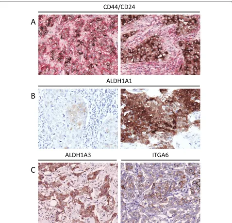 Figure 2 Photomicrographs of CSC marker expression in invasive breast carcinomaALDH1A1 expression.low