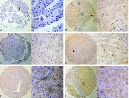 Figure 1. Representative immunohistochemical staining of SIRT4 in human hepatocellular carcinoma tissues