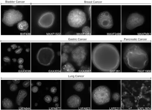 FIGURE 2 3D cultures of patient-derived xenograft (PDX) material. PDX material from  different tumours can be cultured in 3D hydrogels to form complex micro-tissues  that can be used for compound screening in a physiologically- and patient-relevant  contex