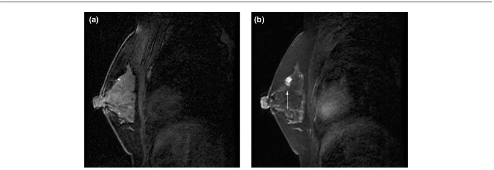 Figure 2MRI results in a 46 year old woman at high risk for breast cancer. Sagittal pre-contrast T2 (a), post-contrast T1 (b) and magnified view (c) of8 × 3 × 3 linear focus of enhancement in left breast at six o’clock (arrowed)