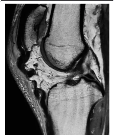 Figure 3 Lateral radiography (a) and computed tomography with three-dimensional reconstruction (b) of the right knee shows thepresence of patella alta (Insall-Salvati index (Length of the patella/Length of the patella tendon) = 1.6) and ectopic calcification alongthe patellar tendon in case 1.