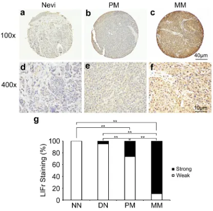 Figure 1: LIFr expression is increased in human advanced melanoma. Representative images of LIFr immunohistochemical staining in nevi, primary melanoma and metastatic melanoma TMA