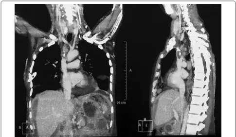 Fig. 2 CT venography chest and abdomen showing hypodense superior vena cava and infra renal inferior vena cava suggestive of thrombosis with mid ascites with omental thickening