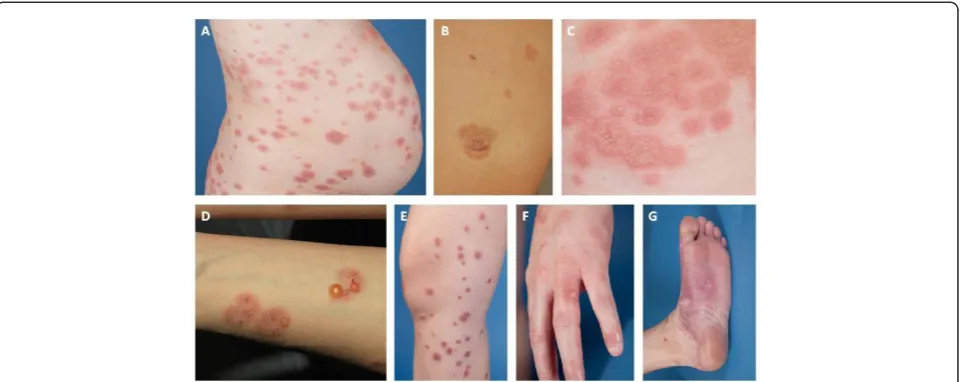 Figure 1 Skin findings of gestational pemphigoid (PG). Urticarial papules and plaques usually appearing first on abdominal area (A)