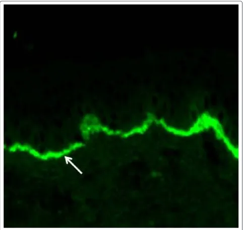 Figure 2 Linear complement 3 (C3) (arrow) fluorescence in immunofluorescence analysis of perilesional skin biopsy is diagnostic forgestational pemphigoid