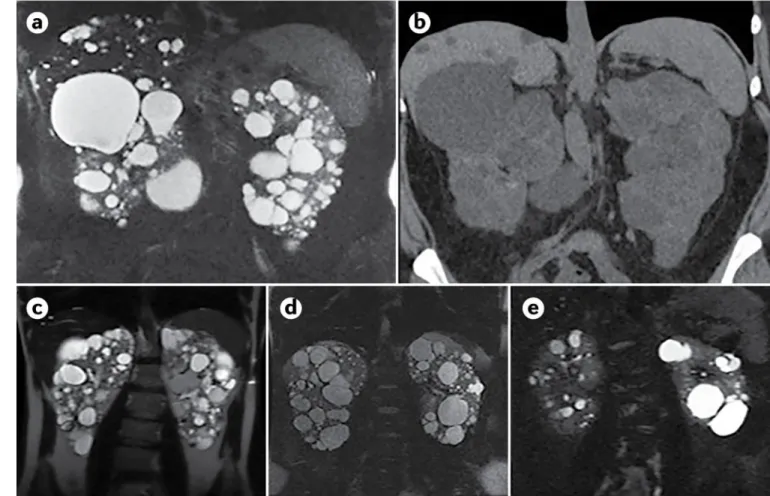 Fig. 7 |. Diagnosis of autosomal dominant polycystic kidney disease using different imaging  techniques.
