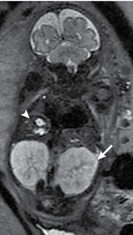 Fig. 8 |. Diagnosis of autosomal recessive polycystic kidney disease using MRI.